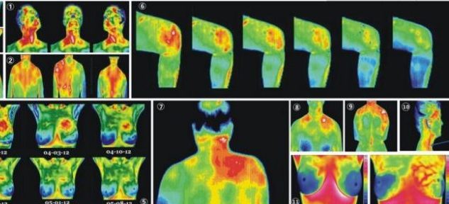 紅外熱成像儀——腫瘤診斷新手段