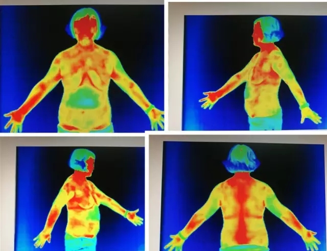 熱成像開辟了以功能學(xué)為主的全新醫(yī)學(xué)影像領(lǐng)域